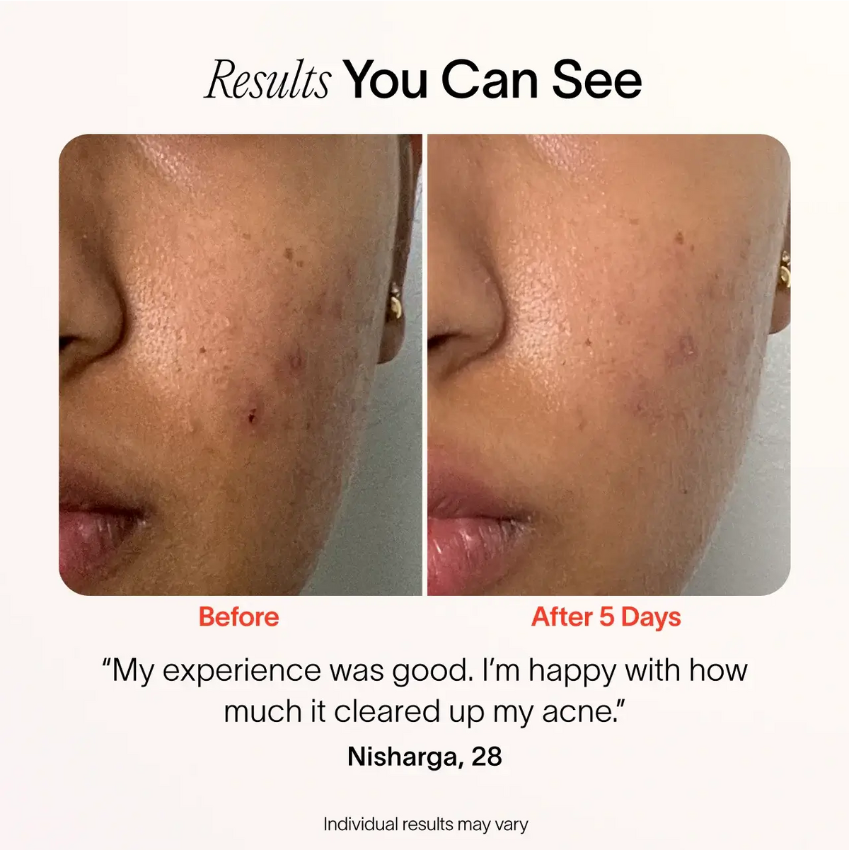 Solawave Bye Acne 3-Minute Pimple Spot Treatment skincare tool in periwinkle color, used for quick blemish relief.