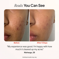 Solawave Bye Acne 3-Minute Pimple Spot Treatment skincare tool in periwinkle color, used for quick blemish relief.