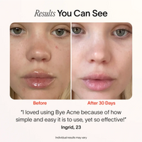 Solawave Bye Acne pimple spot treatment device in periwinkle, a skincare tool designed for quick acne spot treatment.