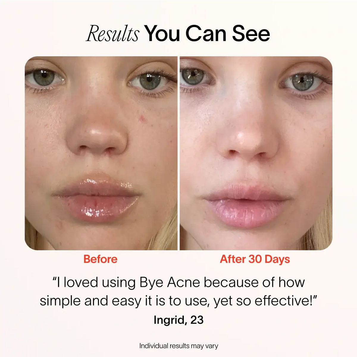 Solawave Bye Acne 3-Minute Pimple Spot Treatment skincare tool in periwinkle, designed to target blemishes quickly.
